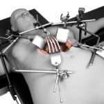 BARIATRIC RETRACTOR SYSTEM - Retractor System