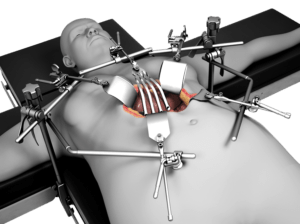 BARIATRIC RETRACTOR SYSTEM - Retractor System